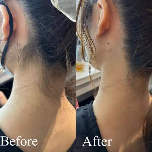 👶🏻12月限定うなじ脱毛👶🏻