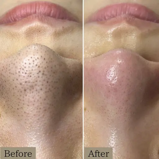 《1番人気》【黒ずみ毛穴ケア＆幹細胞ハーブピーリング】黒ずみゴワゴワ肌をつるん肌へ改善へ✨90分15800円