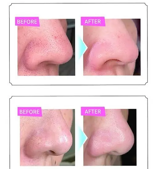 顔全部!毛穴洗浄🧼ハイドロスプラッシュ🛁