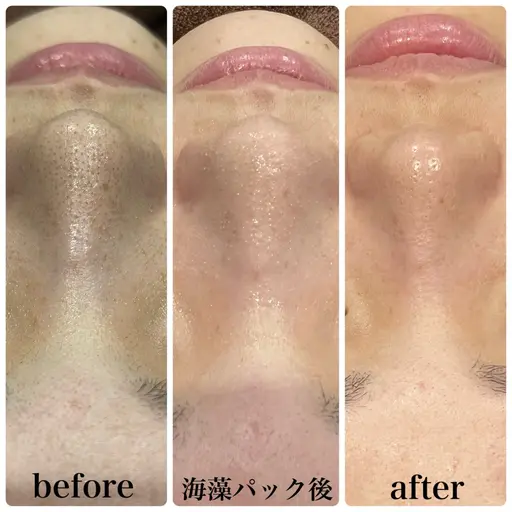 【男女/当日予約&来店限定/花粉や皮脂対策で透明肌へ】全顔3D毛穴洗浄¥4,980