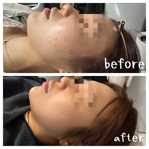 ✨OPEN記念✨【とにかくお肌を綺麗にしたい方💎】ラテスパ&針入りハーブピーリング剥離あり