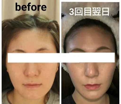 NEW【11月3名様限定】小顔矯正リフトフェイシャル