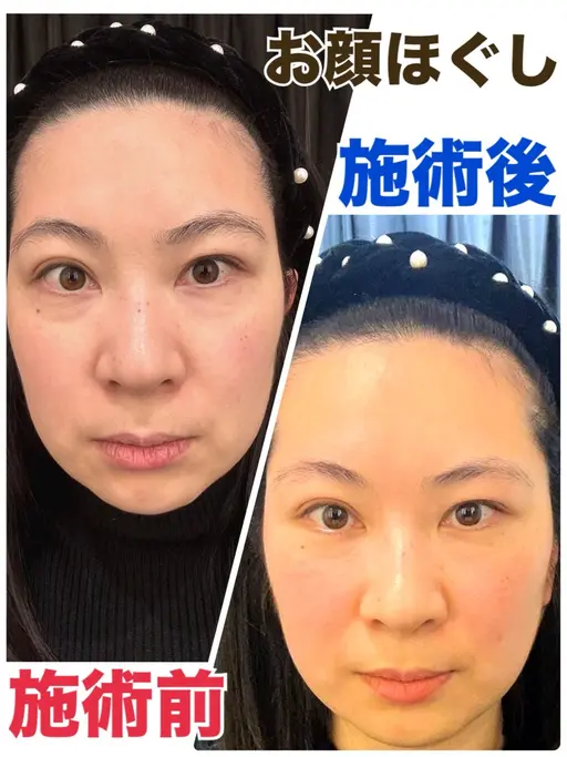 NEW🎁一度でスッキリ✨顔&デコルテ集中ほぐし【顔筋・デコルテマッサージ】45分【むくみ解消】【小顔効果】【眼精疲労】