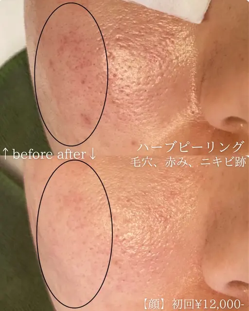 【成人式までにツヤ肌まだ間に合う！】ハードハーブピーリング！ダウンタイム有