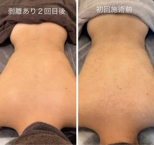 🌿剥離ありハーブピーリング〈背中〉