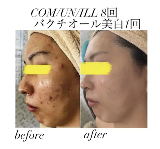 徹底ニキビケア✴️クリスティーナコモデックス✴️トラブル解消&再発防止