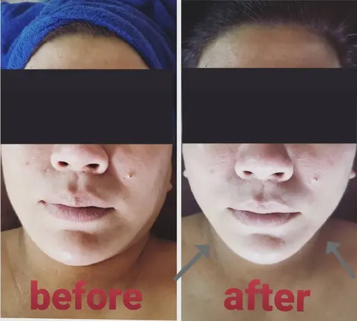 【小顔】お顔回りの筋肉(頭・首・肩・鎖骨・肩甲骨)までしっかりとほぐしお顔の筋肉を引き上げます。