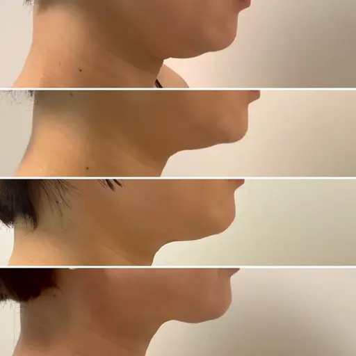 脂肪吸引はまだ早い！ダウンタイムなし！痛みなし！大人気の二重顎、口横のポニョ撃退！脂肪細胞のサイズを小さくする施術です