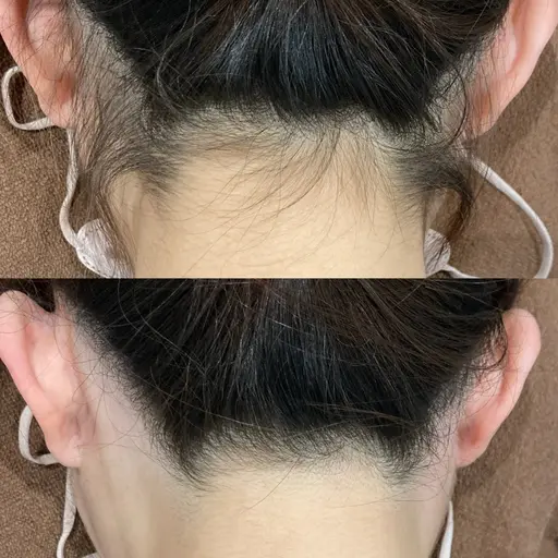 【レディース脱毛】うなじ​〜​お背中上半身/2回まで同じ金額でok◎