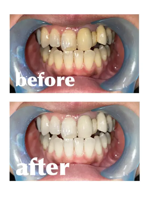 セルフホワイトニング15分