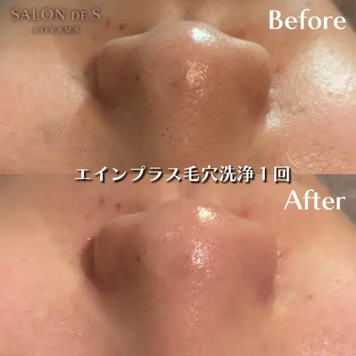 最新毛穴洗浄🫧クリニックで導入されているエインプラスでちゅるちゅる卵肌🥚🤍