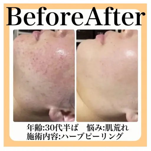 【フェイシャルエステ】ニキビ 毛穴💕剥けない!ハーブピーリング🌿イオン導入付🧖♀️