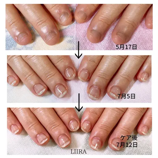 育爪‼️小さい爪、噛み癖、いじり癖、肌荒れなど肌や爪の悩み解決いたします✨理想の爪になれます^^
