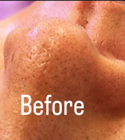 ソフトダーマand水素毛穴洗浄