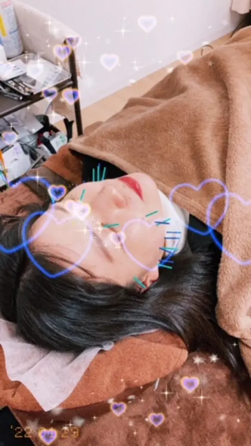 🌸【12、1月限定価格】【火、木、土曜限定】【女性限定】美容鍼　　美容鍼初めての方おススメ💕