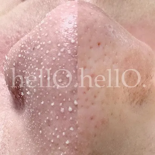 韓国式3D毛穴洗浄　毛穴の詰まりが、比較的ある方を募集しております。　黒ずみがなかなか取れない方大歓迎です。