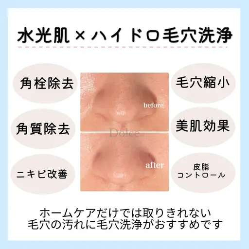 まずはお試し🦙⸝꙳【メンズもOK】水光肌ピーリング×ハイドロ毛穴洗浄