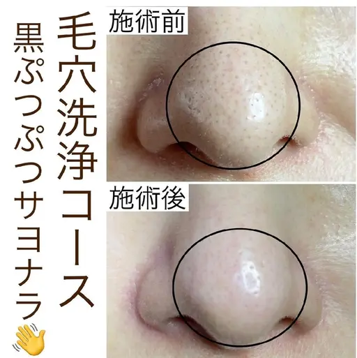 毛穴洗浄