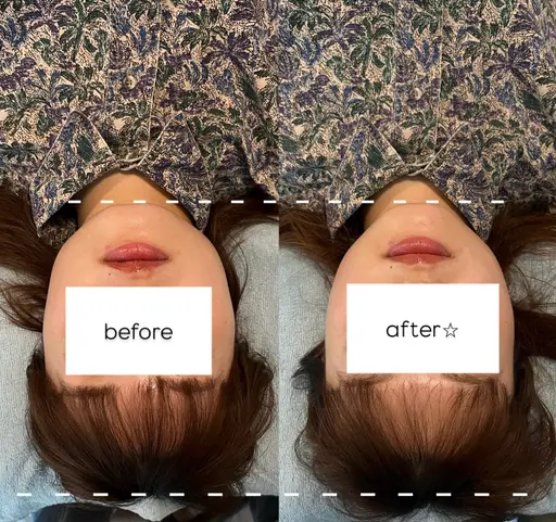 美容鍼 (顔,頭) 🦔🌿🪡