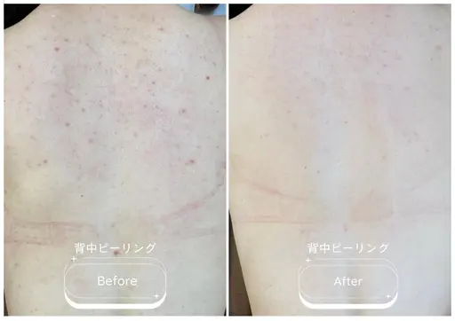 モニター募集🪡背中全体<7日間改善プログラム>剥離有ピーリング◎1週間で背中つるつる🫧ニキビ跡/ニキビ/色素沈着
