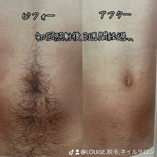 早いもの勝ち！モニター募集！5名様限定！全身脱毛(顔・VIO込み)