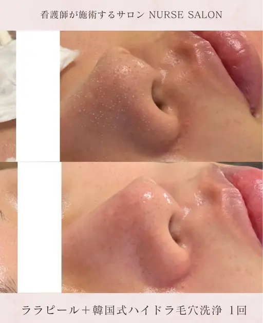 ⭐️12/27.30.1/13.24限定⭐️【全顔ピーリングパック+ハイドラ毛穴洗浄＋水光パック】一回で効果実感の声多数