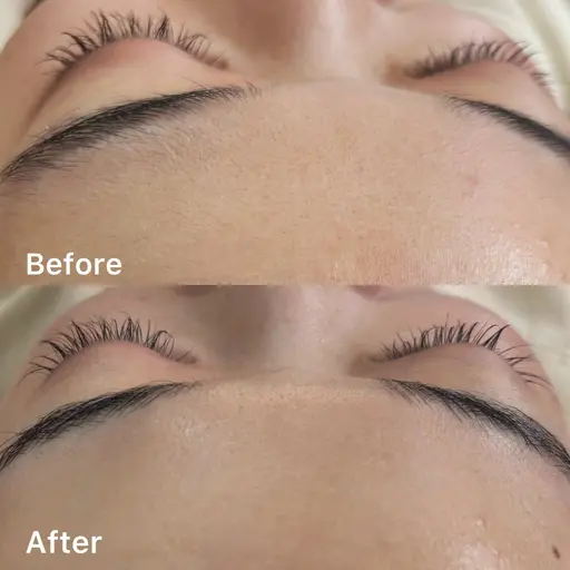 お顔剃り(フェイスシェービング)💆🏼‍♀️💎✨