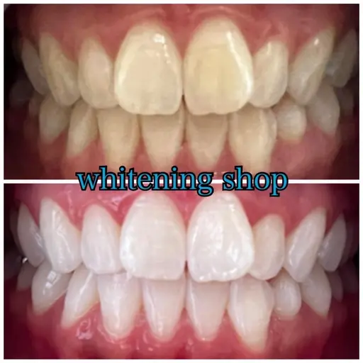 【💓魅力的な笑顔に 💓】ホワイトニング20分×2回 ¥8800→¥1980