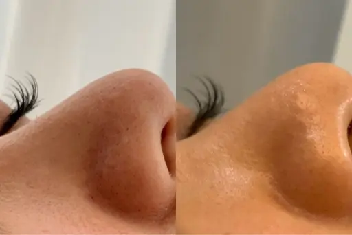 【毛穴洗浄ハイドラフェイシャル】黒ずみ/角質角栓/メイク詰まり/ざらつき