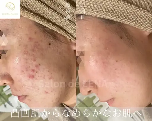 【2パーツお試しハーブピーリング🌿】剥離あり&剥離なしの同時ケア♪額・右・左頬・鼻&顎から2箇お選び頂けます。