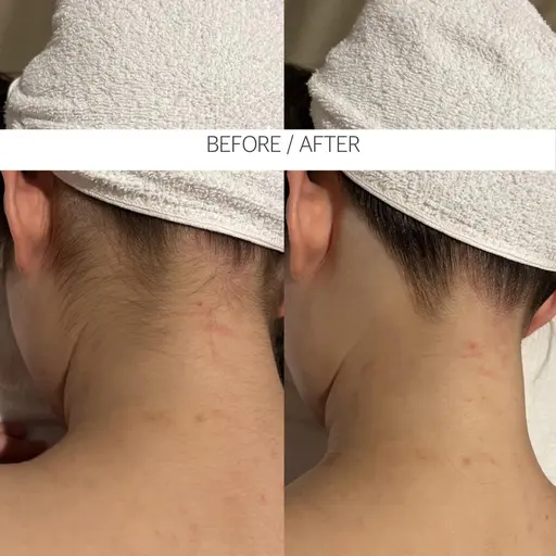 【うなじ脱毛】フォトRF脱毛使用　¥2,980