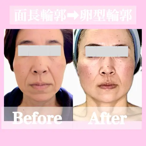 🟡 3/14土曜日施術モデル様募集【たるみ改善Vリフトフェイシャル】無料撮影モデル募集🔴ご利用条件要確認