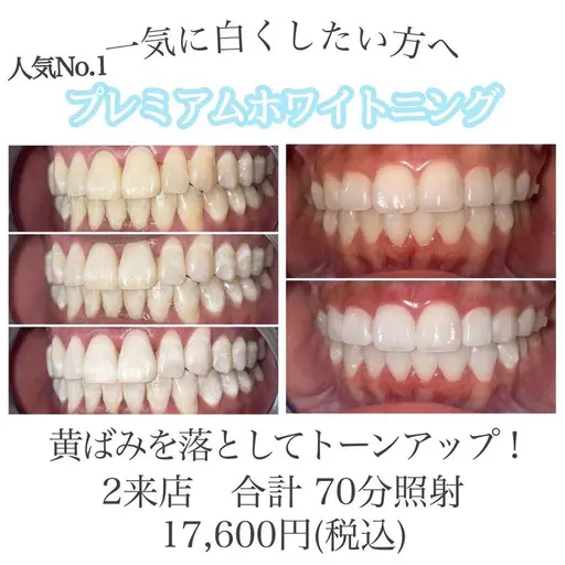 【人気No.１】プレミアムホワイトニング 2来店合計70分 輝く白い歯へ🦷✨