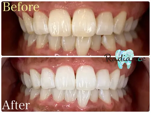 【人気No.1】初回15分3回照射🦷一気に白く！オーダーメイドセルフホワイトニング🦷確実に白くしたい方にオススメ！