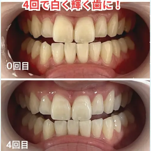 セルフホワイトニング 15分 6,200円→3,300円