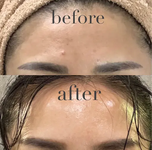 🉐お肌ピカピカコース→酵素洗顔パック→乳酸ピーリング→幹細胞美容液導入→パック→コラーゲンマシーン→保湿→日焼け対策