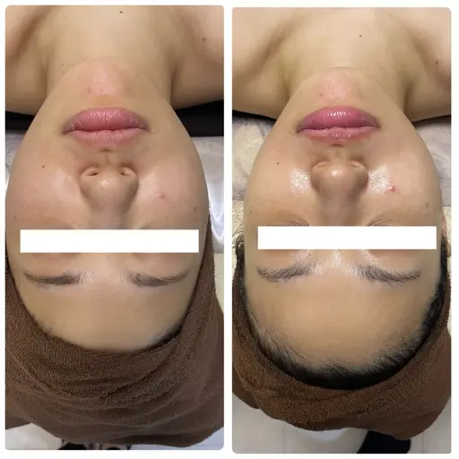 スッキリ小顔‼️(ヘッドマッサージ付き)