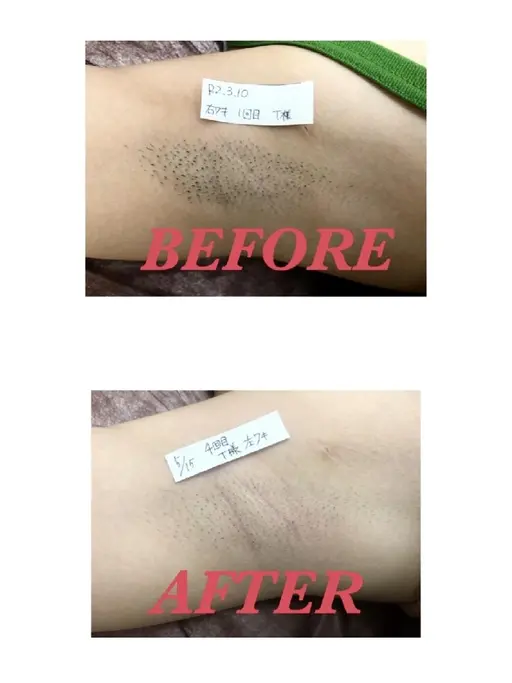 【効果抜群‼️全身脱毛】♥️初回9,800円❤️効果重視の方におすすめ🤗脱毛初心者様🔰にもおすすめです🤩