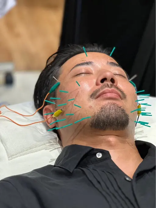 【鍼】美顔鍼or頭鍼トータル　トライアルコース　11300円→8000円!!