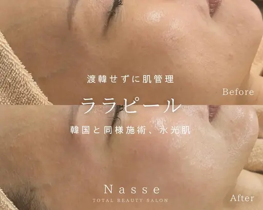 【韓国肌管理/毛穴/艶肌】ララ ピール(首込み)¥9800