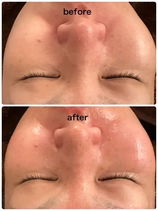 独自の施術【水光ツヤピーリング×保湿パック付】最新美容＊ツヤ/ハリ。どこよりも最安値になります。WiQoでツヤ肌へ​〜​