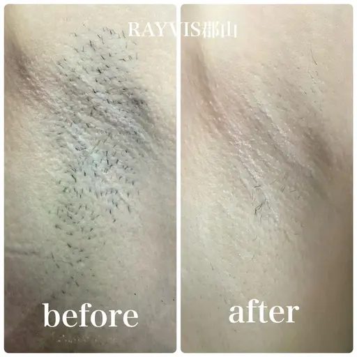 🍭エステデビュー☆両ワキ脱毛10回￥500　Ｌパーツ脱毛1回プレゼント❣️