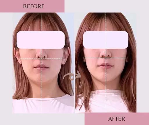 《当日予約限定》加工も整形も不要💓中顔面短縮/リフトUP/導入店希少マシンでエラ張りも解消✨頭蓋骨小顔矯正70分