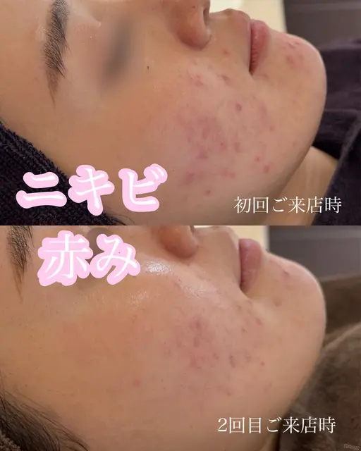 🌟3ヶ月フェイシャルモニター募集🌟赤み・ゆらぎ・ニキビ肌🫧ハーブピーリング/クリスティーナ/フェイシャルエステ