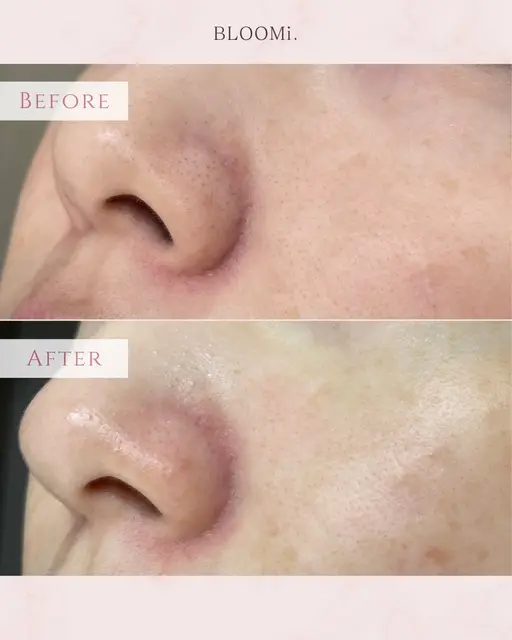 【小鼻のワックス脱毛】毛穴とさようなら