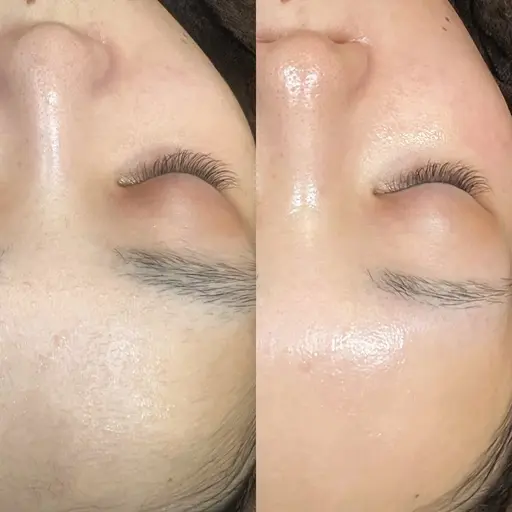 【minimo限定🩷】フェイシャル脱毛ワックス×産毛や角質除去 ✨即日効果あり⭕️