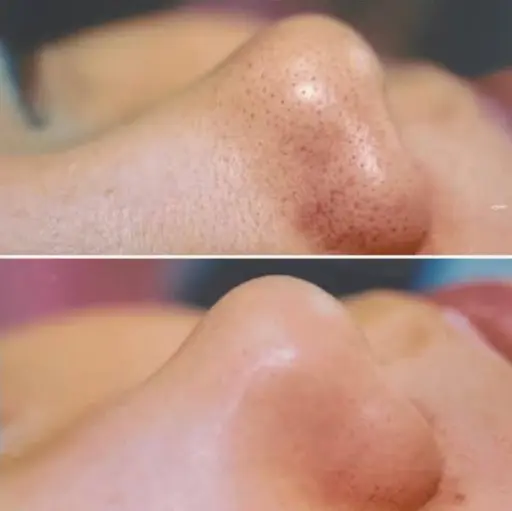 【毛穴黒ずみ角栓レスキュー】『毛穴吸引コース』ヘッドマッサージ付き