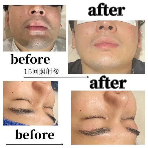 ●ミニモ限定【全顔メンズ脱毛＋眉ワックス脱毛】◎¥4700