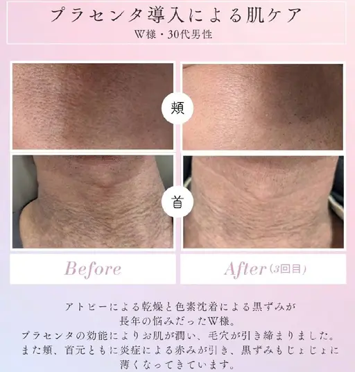 【メンズもOK】プラセンタフェイシャル（高速エアジェット）30分