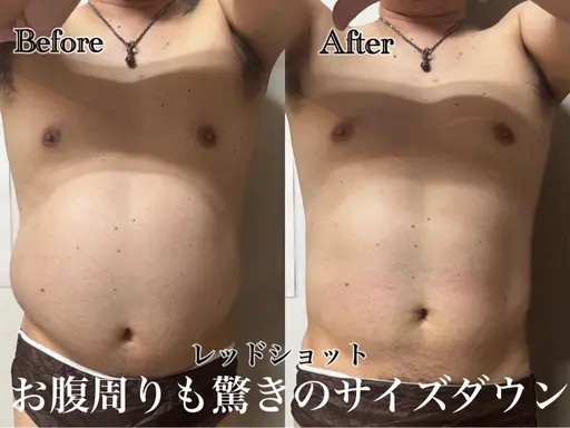 【レッドショット導入価格✨️】韓国発🇰🇷最新美容脂肪撃退🚨二の腕orお腹3cc導入✨️EMS、ラジオ波付き⸜❤️⸝